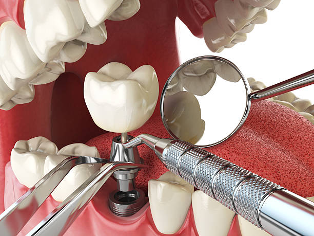 Best Emergency Denture Repair in Bethel Island, CA